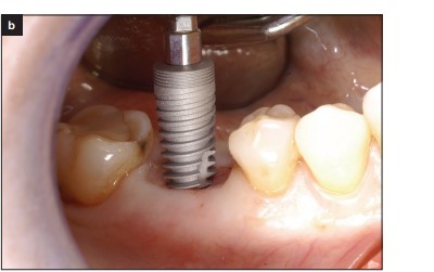 Ritter Implants Research